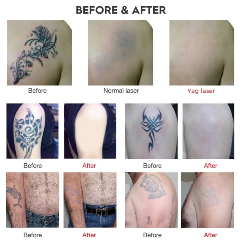 Multi-Head Laser Machine For Tattoo And Skin Rejuvenation 1320nm Wavelength Q