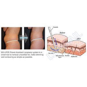 300W Surgical Liposuction Machine for Upper / Lower Back Liposuction