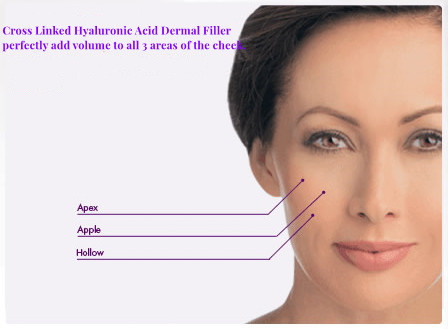 Buy Injectable Sodium Hyaluronate Dermal Filler Midface Volume Loss Treatment Plump Cheek at wholesale prices