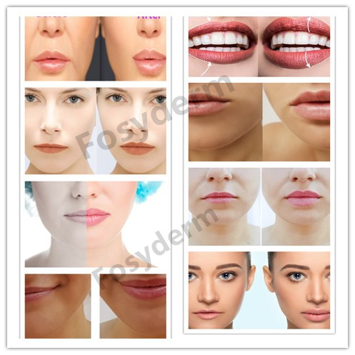 Cross Linked HA Dermal Filler For Anti Wrinkles Enhancing Lips
