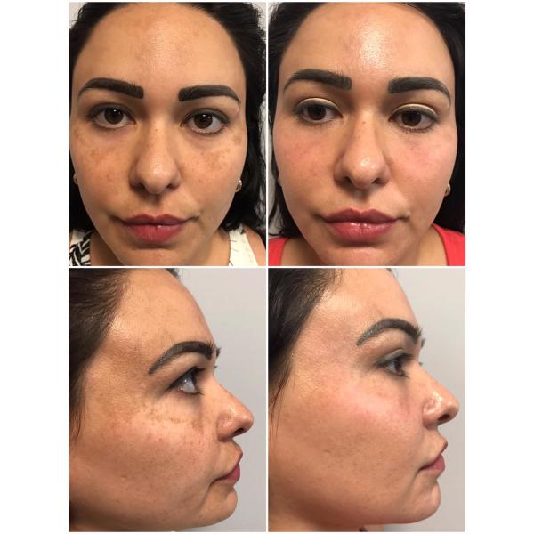 30W power 10600nm scar removal device CE approved fractional CO2 laser stretch marks