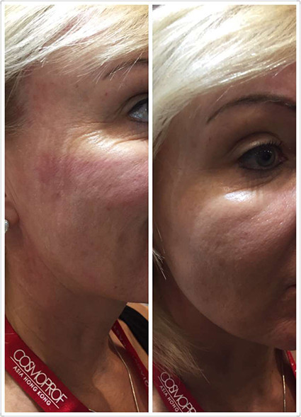 Beautiful Design High Quality Manufacturer Direct Sale Portable Cryolipolysis Machine For