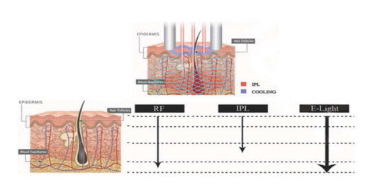 Portable IPL Beauty Machine With Touch Screen For Hair Remover N6B-Carina