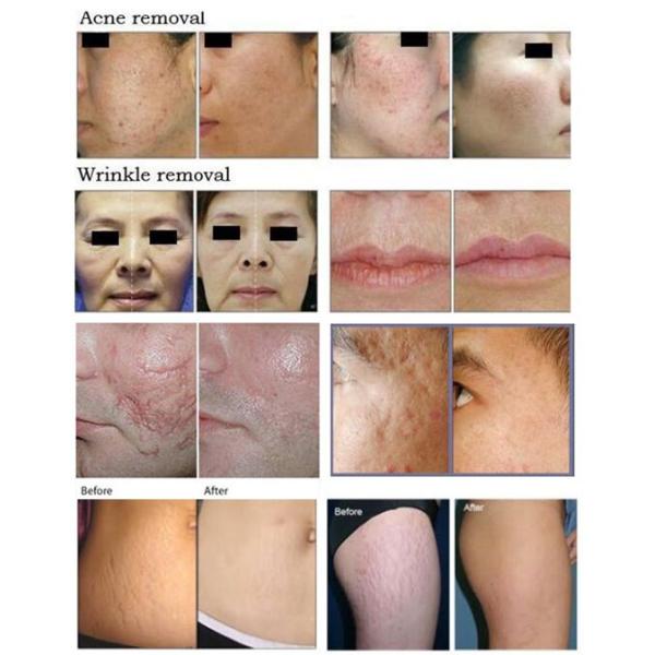 Scar removal vertical Co2 fractional RF tube dark spots / Acne removal machine