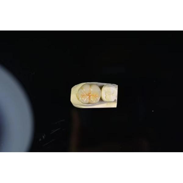 FDA PFM Crown Porcelain fused to Metal Crown