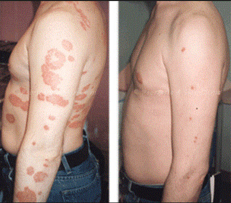 Treating Psoriasis UVB Light Therapy Machine , Stability Light Therapy For Eczema