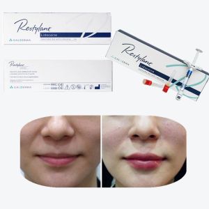 Vital Perlane Cross Linked Dermal Filler Hyaluronic Acid Lyft Dermal Fillers