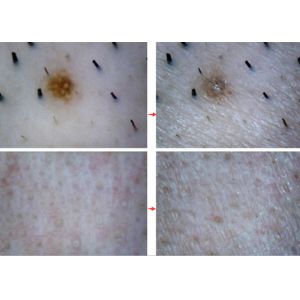 Smart Video Dermatoscope Facial Skin Camera Moisture HD Intelligent Skin