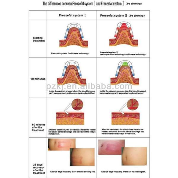 cryolipolysis machine CE , portable cryolipolysis fat freeze slimming machine