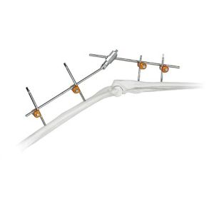 China Orthopedic Surgical Implant Medical Elbow External Fixator Device on sale