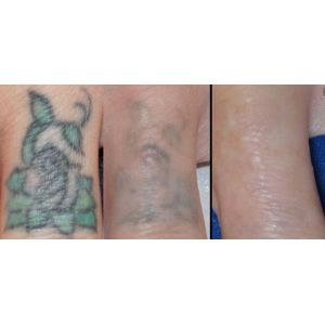 532nm 1064nm 1320nm Q Switch ND Yag Laser Machine For Skin Whitening / Dark