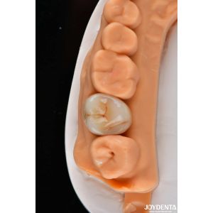 Dental Multilayer Full Zirconia Crowns And Bridges High Translucent Natural
