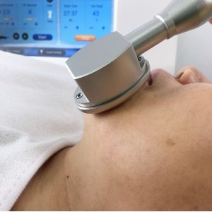 Selectable Depth 2MHZ Microneedling Fractional RF Scar Reduction