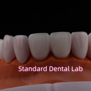 Abrasion Resistant Emax Zirconia Laminate Veneers Incisal Translucency