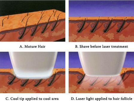 12*20 big spot 808nm portable diode laser hair removal/laser hair removal machine diode