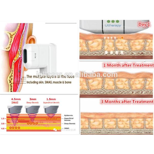 High Intensity Focused Ultrasound HIFU Machine Ultrasonic Facial Machine CE