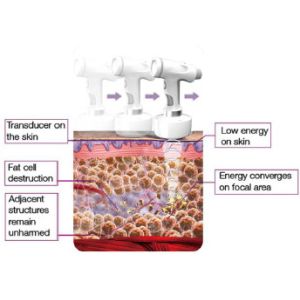 hifu fat removal non surgical removal of fat