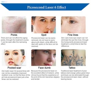 Beauty Salon Use Picosecond Tattoo Removal Machine For Freckle Removal