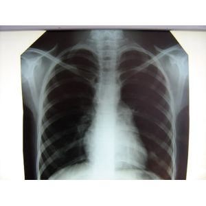 China Hospital Clear Medical X-Ray Film Konida With Thermal Printers on sale