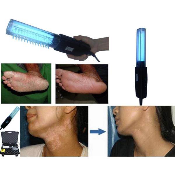 Buy Portable 311nm Uvb Phototherapy Lamp 250V Vitiligo Lamp Treatment at wholesale prices