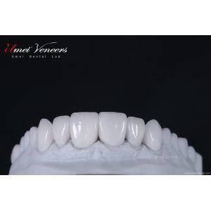 Transparent and smooth porcelain veneer