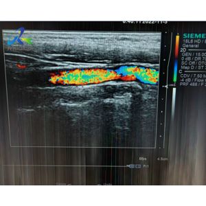 Siemens 18L6 Ultrasound Probe Repair Transducer Lens Replacement