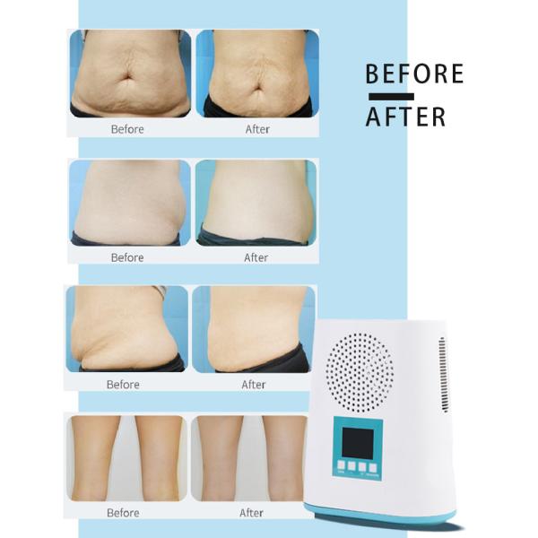 2020 hot selling portable mini cryo fat freezing/cryo slimming machine/fat eduction