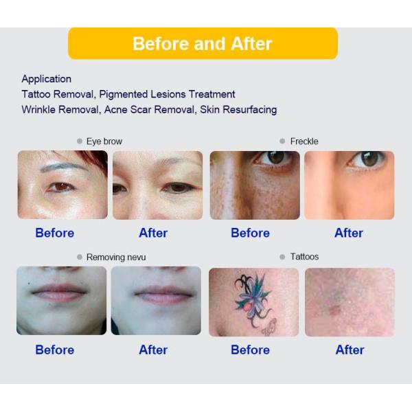 Nd Yag Picosecond Q Switched Nd Yag Laser 2025 Picosecond Laser Tattoo Removal Beauty Machine Laser Picosecond