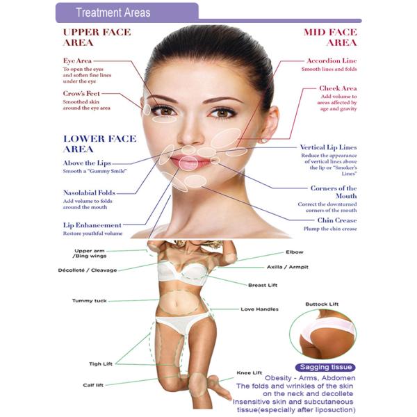 Portable Beauty Facial Thread Screw Body Lift Absorbable Polydioxanone Suture Thread