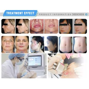 10600nm Fractional Co2 Laser Skin Resurfacing Machine Erbium Yag Laser