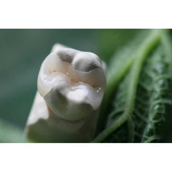 Onlay And Inlay Esthetic Artificial EMAX Dental Crown