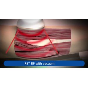 LCD Display Physio Tecar Indiba Diathermy Machine Cet Ret 448khz