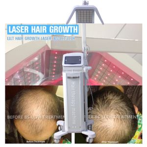 Energy Adjustable Hair Laser Growth Machine With 650nm / 670nm Wavelength Real