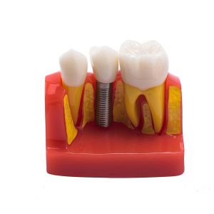 Class III Instrument Classification Dental Study Model for Dental Practice and