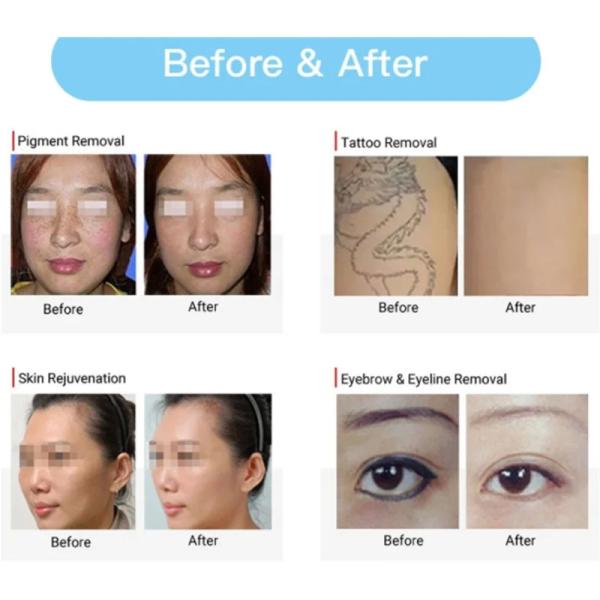 4 Wavelengh Laser Tattoo Removal Machine Picosecond For Pore Remover Carbon Peel