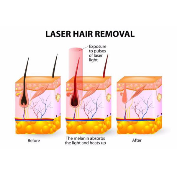 808nm Professional Diode Laser Hair Removal Machine Used For Salon SPA