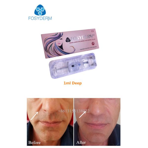 1ml 2ml cosmetic dermal filler For Deep Wrinkles HA Gel Injection CE