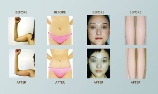 Portable lipo laser for fat loss and body slimming