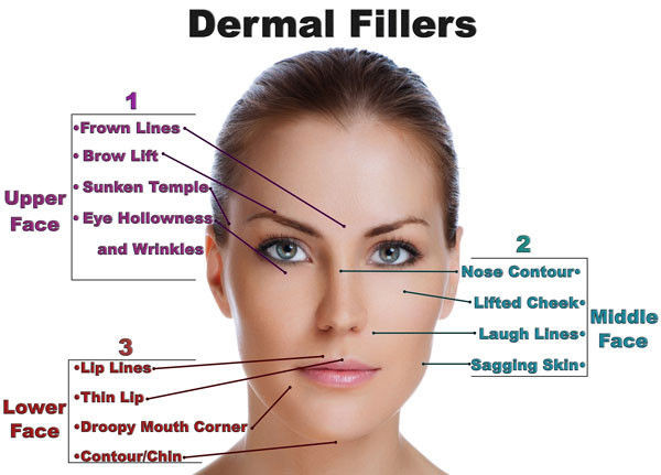 Derm Deep Hyaluronic Acid Fillers Nasolabial Folds / Hyaluronic Acid Gel