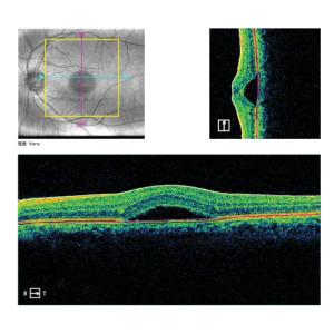 Macular Disease Optical Coherence Tomography System PC Inside