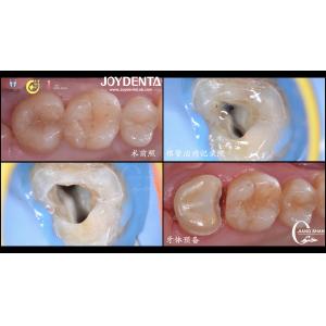 Long Lasting Natural Looking dental ceramic inlay Precise Fit High Compatibility