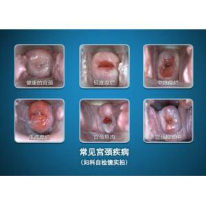 High Definition Display Digital Electronic Colposcope Portable Device to Check