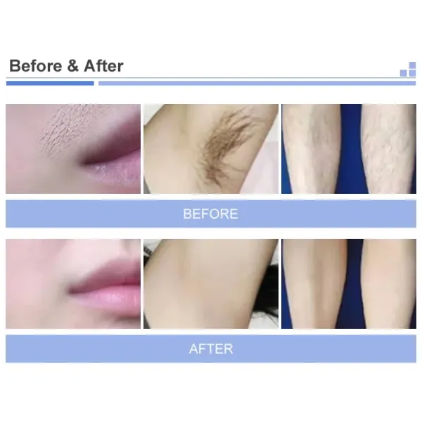 Professional Diode Laser Hair Removal Machine with 3 Wavelengths 808nm 755nm 1064nm 600W-1800W Power and Two Years Warranty