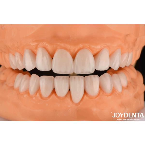 Buy Ceramic Emax Veneers 0.3-0.5mm Thickness Long Lasting Cosmetic Porcelain Veneers at wholesale prices