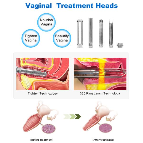 CO2 Fractional Laser Beauty Machine Medical Grade Vaginal Tightening Gynecology Aesthetic Vulva Rejuvenation