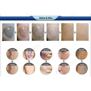 Hot selling salon use Q-Switched ND: YAG Laser Tattoo Removal Machine