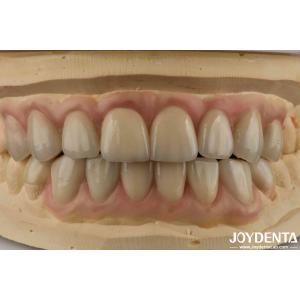 High Translucency Emax Cosmetic Dentistry Veneers High Aesthetics Ultra Thin