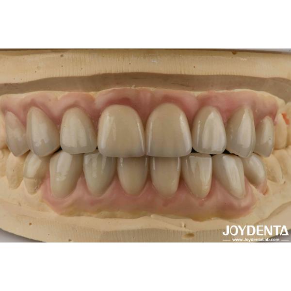 Buy High Translucency Emax Cosmetic Dentistry Veneers High Aesthetics Ultra Thin at wholesale prices