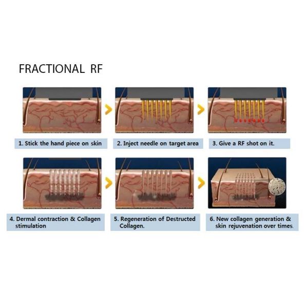2 In 1 Lipo Laser And Fractional Radio Frequency Machine For Skin Tightening High Efficiency