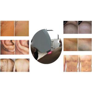Professional permanent hair removal 808nm diode laser hair removal